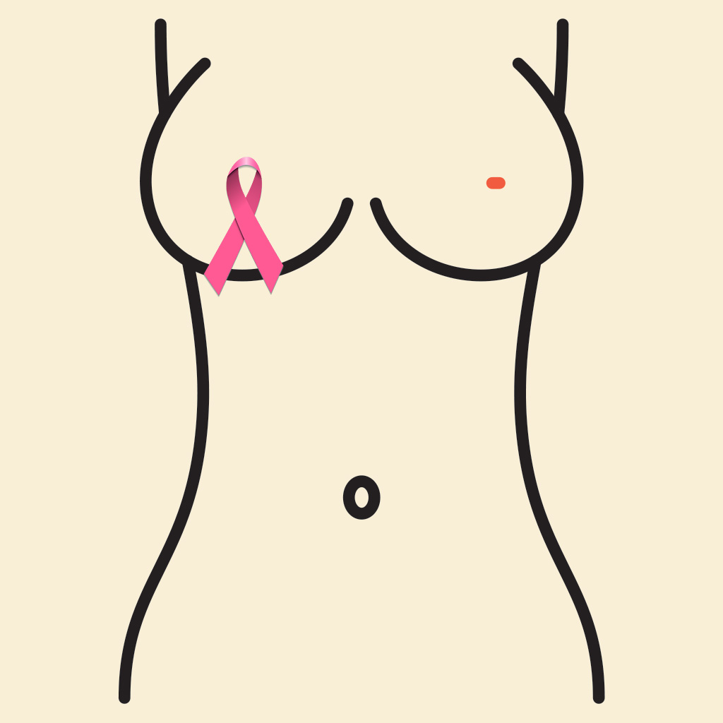 Brustrekonstruktion nach Krebs