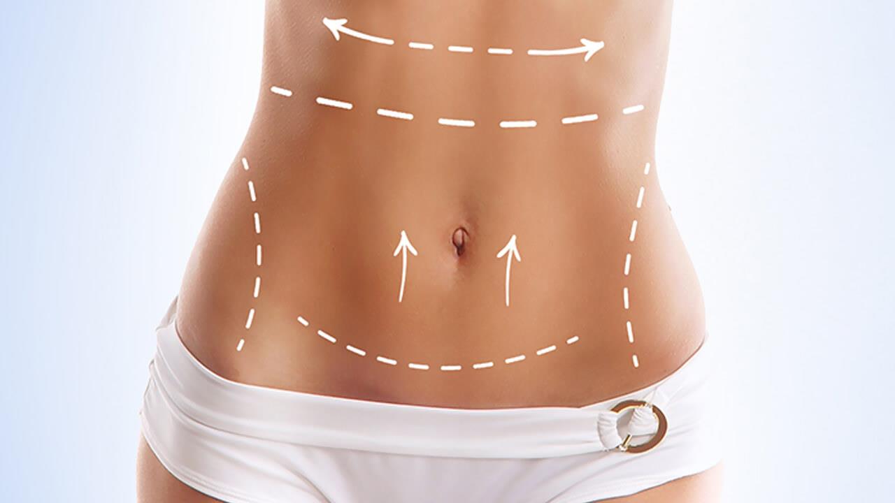 Bauchdeckenstraffung (Abdominoplastik)