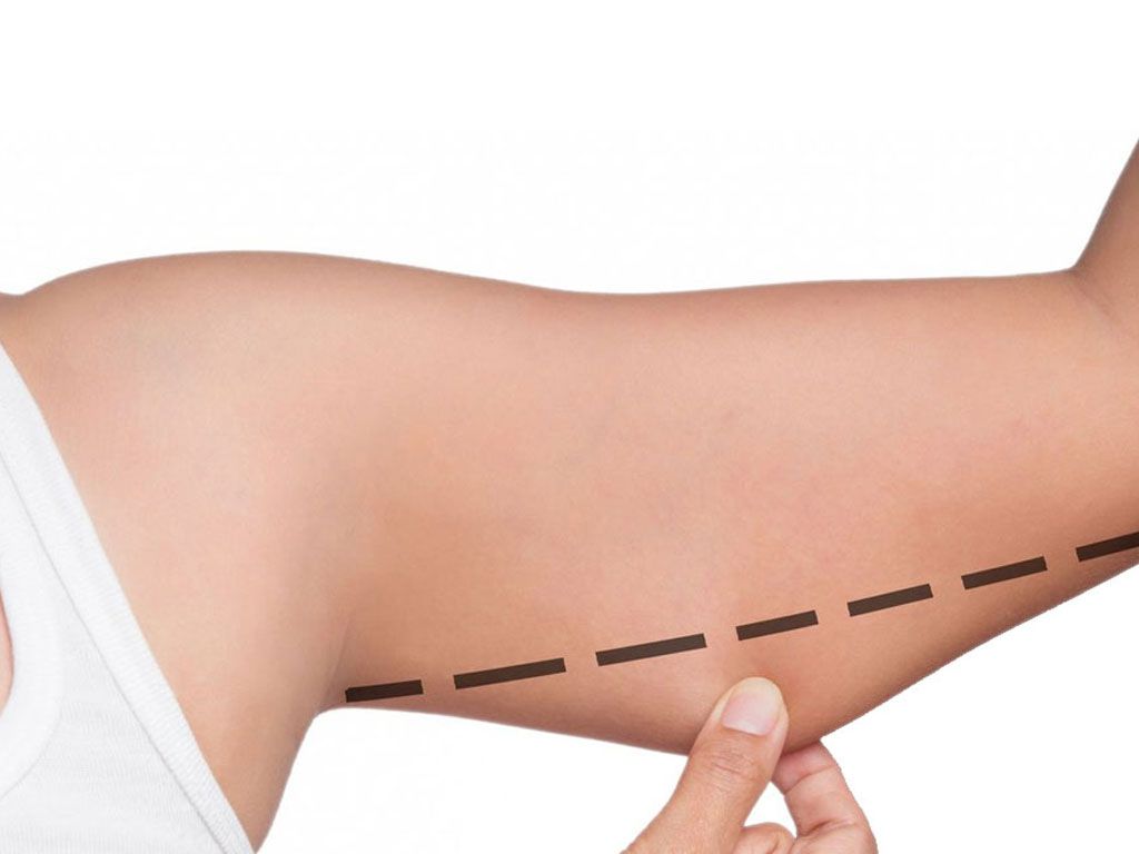 Oberarmstraffung (Brachioplastik)