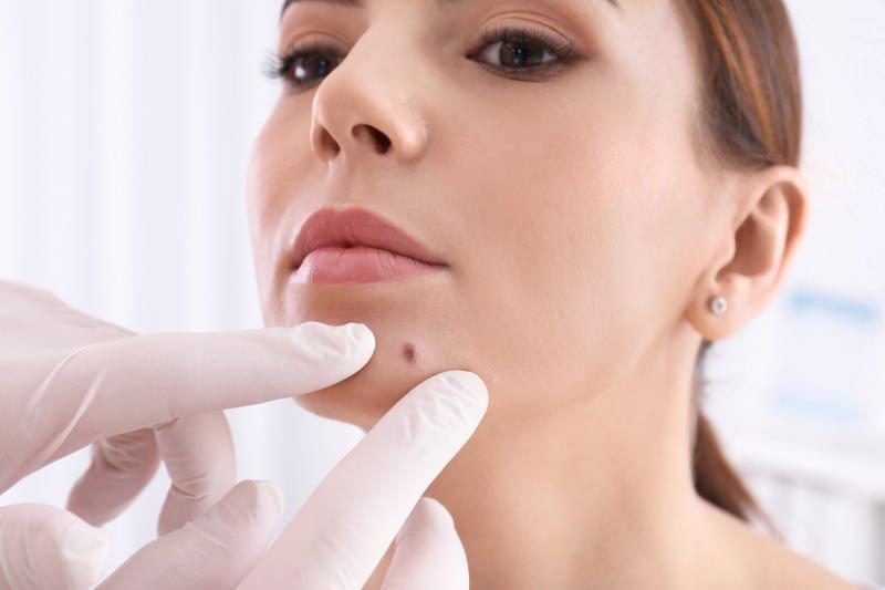 Nevus eksizyonu (Ben Alımı)